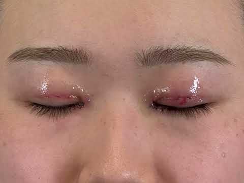 注入施術や糸リフトの痛みを徹底比較！治療ごとの痛みのレベルを教えます！