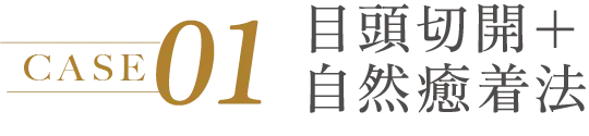 CASE 01 目頭切開+自然癒着法