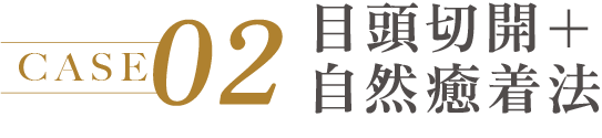 CASE 02 目頭切開+自然癒着法