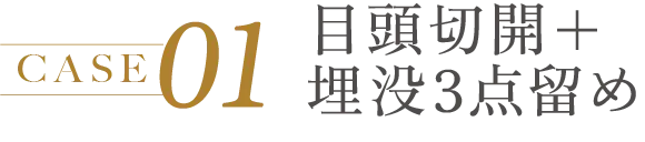 CASE 01 目頭切開+埋没3点留め