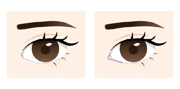 スキンリドレープ法 before after