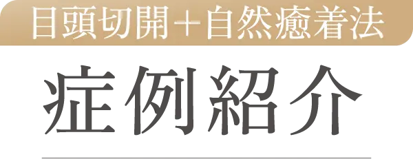 目頭切開+自然癒着法 症例紹介
